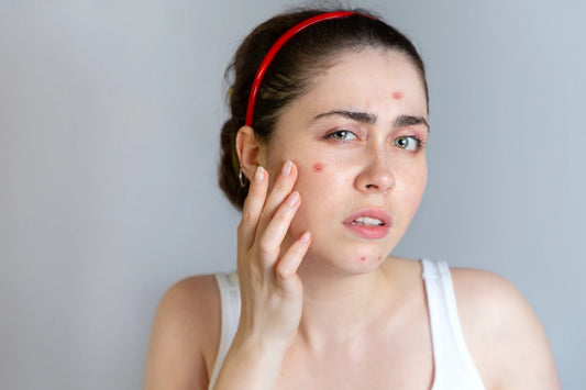 Top 6 Ways to Get Rid of Acne - Vitabowl